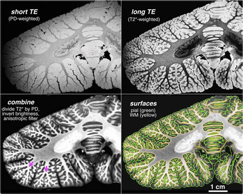 Coronal High Resolution Mri Images Of The Human Cerebellum Short And