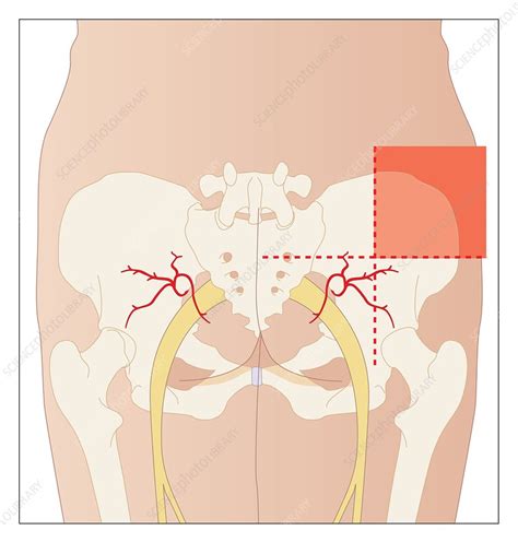 Dorsogluteal Injection Site Artwork Stock Image C008 4830 Science Photo Library