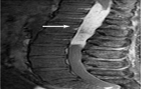 Mri Of Conus Medullaris Cauda Equina And Filum Terminale L