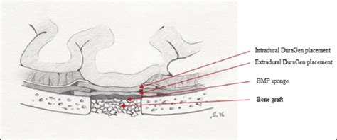 Repair of encephalocele and cerebrospinal fluid leak with the use of