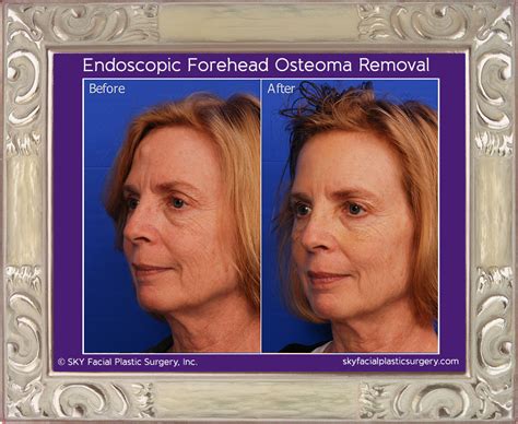 Endoscopic Forehead Procedures San Diego Lipoma Osteoma Brow — Sky