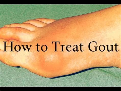 Gout, a kind of joint disease called arthritis, occurring due to uric acid building up in the blood and thus causing joint inflammation. How to Treat Gout - Get Rid of Gout - YouTube