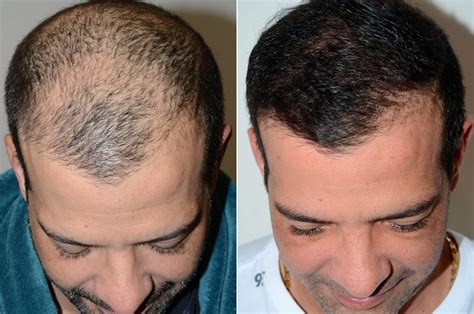 Hair Transplants For Men Pictures Miami Fl Paciente 58764