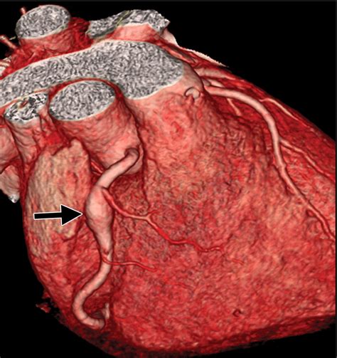 Coronary Artery Aneurysms And Ectasia Role Of Coronary Ct Angiography