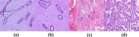 Microscopic Patterns Of Benign Breast Tumor A Fibroadenoma