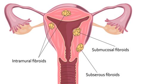 Uterine Fibroids Symptoms Causes And Treatment Tata Mg Capsules