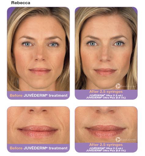 Juvederm Facial Filler Maryland Oral Surgery Associates