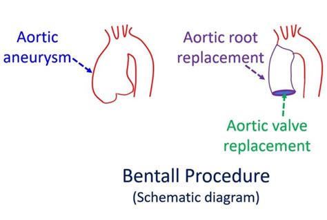 What Is Bentall Procedure All About Heart And Blood Vessels