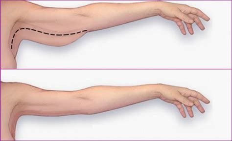 Get Slimmer Arms How To Get Rid Of Arm Cellulite