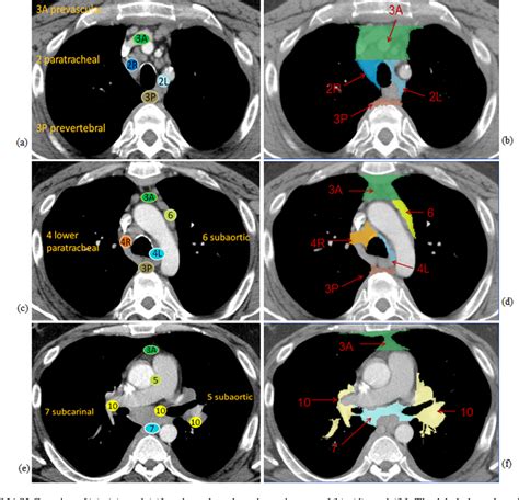 Mediastinal lymph node detection and station mapping on chest CT using spatial priors and random ...