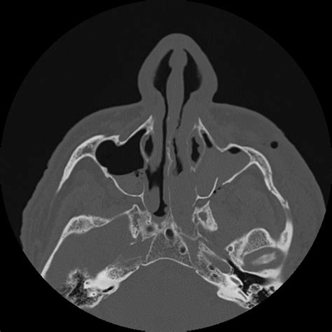 Figure Face Ct Tripod Fracture Contributed By Scott Dulebohn Md
