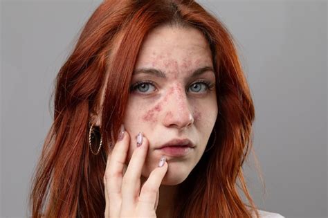 Jeune Femme Présentant Une éruption Cutanée Aiguë Sur Le Visage