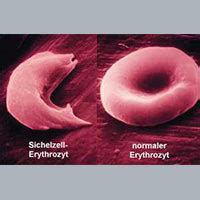 Die sichelzellenanämie ist eine erbliche erkrankung der roten blutkörperchen (erythrozyten). Drepanozytose - Kann CBD bei Sichelzellenanämie helfen ...