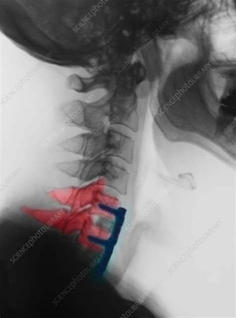 Cervical Xray Showing Spinal Fusion C5 C6 C7 Stock Image F018 9114 Science Photo Library