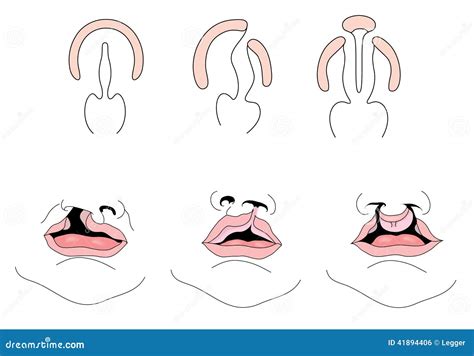 Drawing Of Cleft Palate And Cleft Lip Illustration 41894406 Megapixl