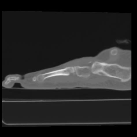 Avulsion Fracture Of The Dorsal Cuboid Bone Image