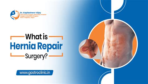 What Is Hernia Repair Surgery Dr Kapileshwer Vijay