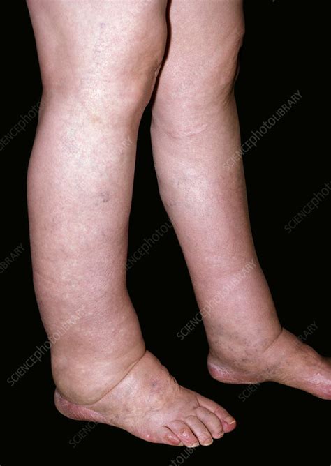 Lymphoedema Of The Legs Stock Image C0515151 Science Photo Library
