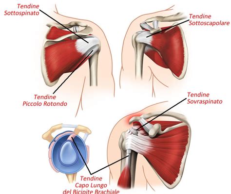 Scoraggiare Scopo Sedativo Lesione Tendine Spalla Esercizi Arashigaoka