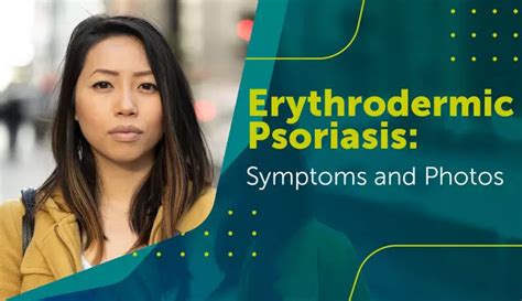 Erythrodermic Psoriasis Symptoms And Photos Mypsoriasisteam