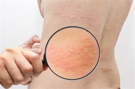 10 Best Home Remedies For Hives Urticaria