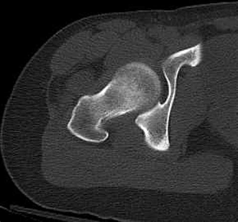 Anterior Hip Dislocation 5 Months After Hip Arthroscopy Arthroscopy
