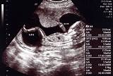 Taken at 4 weeks, the ultrasound image shows a gestational sac. 17 Weeks Pregnant Symptoms, Ultrasound, Belly, Baby ...