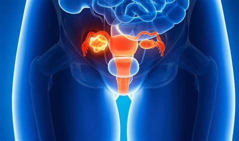 The most important thing, according to rebecca brightman, md, assistant clinical professor of obstetrics, gynecology, and reproductive science at mount sinai, is listening to your body. Ovarian cancer symptoms: Breakthrough treatment drug ...