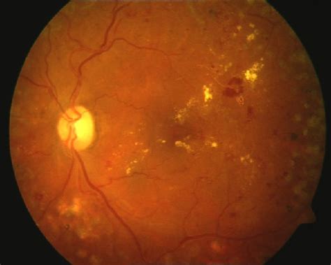 Automated Diabetic Retinopathy Detection System
