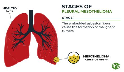 Why Is Mesothelioma So Deadly Elg Law