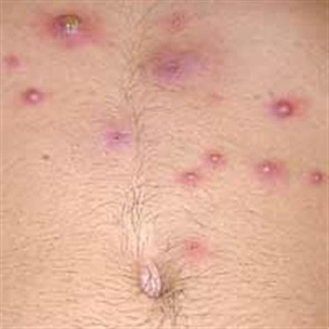 Mrsa is a staph germ (bacteria) that does not get better with the type of antibiotics that usually cure staph infections. MRSA | Lakes Region Partnership for Public Health ...