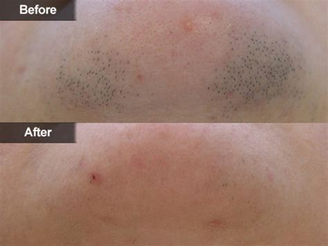 Laser Hair Removal Mclean And Woodbridge Va Skin And Laser Center