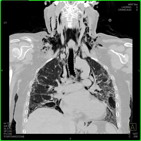 Interstitial Lung Disease With Spontaneous Pneumomediastinum And