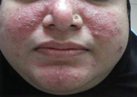 Bright Red Discoloration Of The Malar Region And Chin Open I