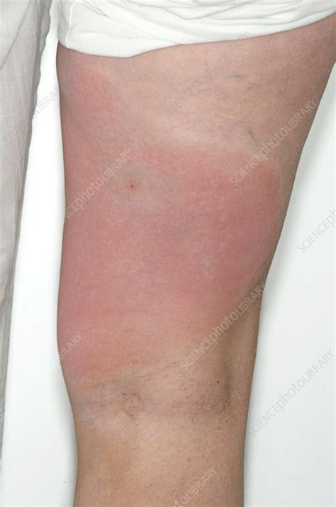 Allergic Reaction To An Insect Bite Stock Image C Science Photo Library