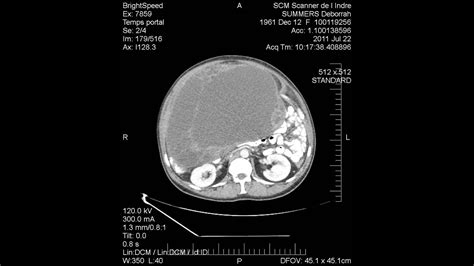CT Scan Of Ovarian Cyst YouTube