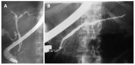 Role Of Endoscopic Retrograde Cholangiopancreatography In Acute