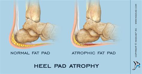 Atrophy Of The Heel Pad Mass4d Foot Orthotics