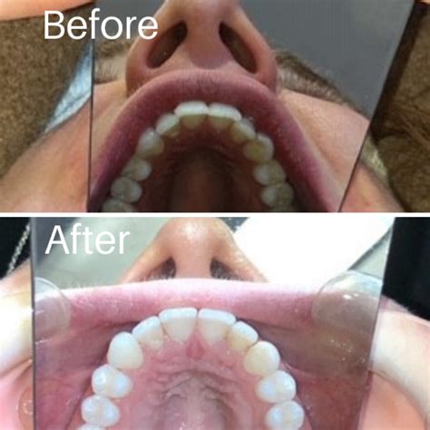 Align Spires Oral And Dermal Care Straight Teeth Clear Braces Invisalign