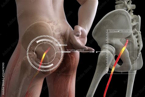 Pinched Human Sciatic Nerve Anatomical Vision 3d Illustration Stock