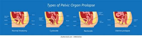 Pelvic Floor Prolapse Type Uterine Uterus Vector C S N Mi N Ph B N Quy N