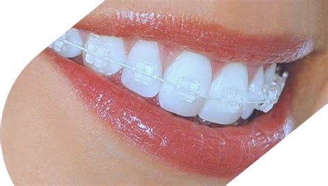 Invisible Braces Highland Orthodontic Practice Inverness