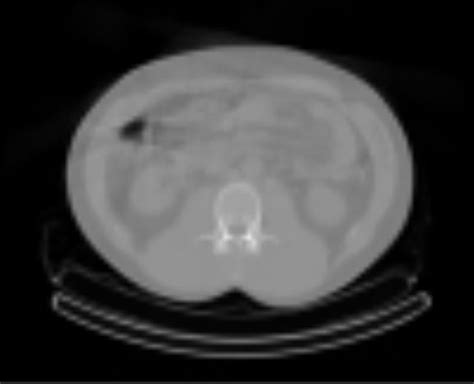A ct or cat scan is a shortened name for computerized tomography. Chest pain: CT scan chest | Respiratory tract disorders ...