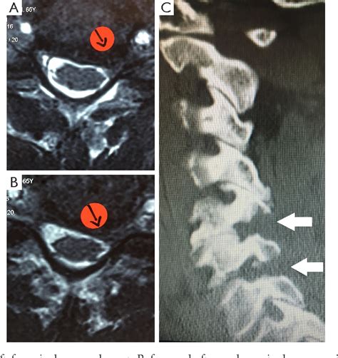 Figure From Minimally Invasive Fully Endoscopic Two Level Posterior Cervical Foraminotomy