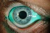 Wikipedia Lasik Eye Surgery Photos