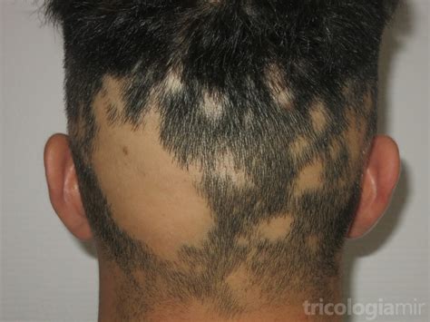 Alopecia Areata Tricología Y Trasplante Capilar Mir