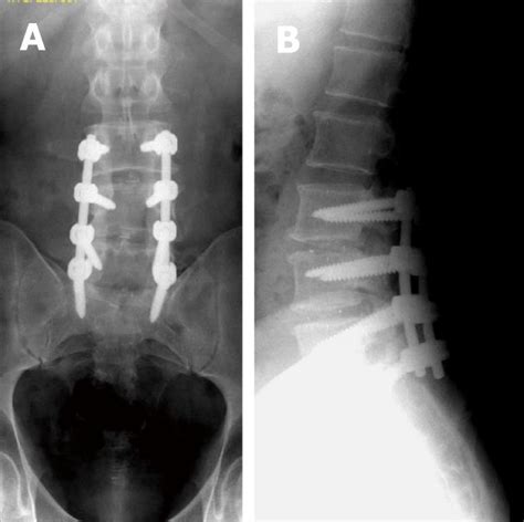 Spinal Fusion Hardware Construct Basic Concepts And Imaging Review Free Nude Porn Photos