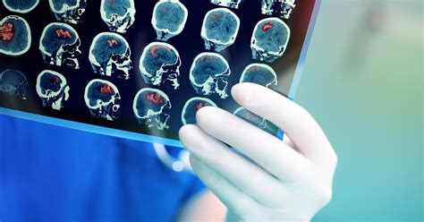 Brain Tumor Types Causes Symptoms Diagnosis And Treatment