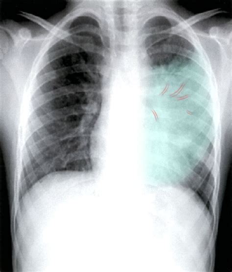 Ventilator Associated Pneumonia Xray