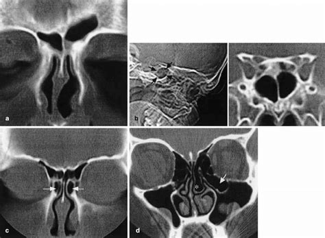 Seyed bashir mirtajani et al, geographical distribution of cystic fibrosis; a Coronal CT scan in a cystic fibrosis (CF) patient with ...